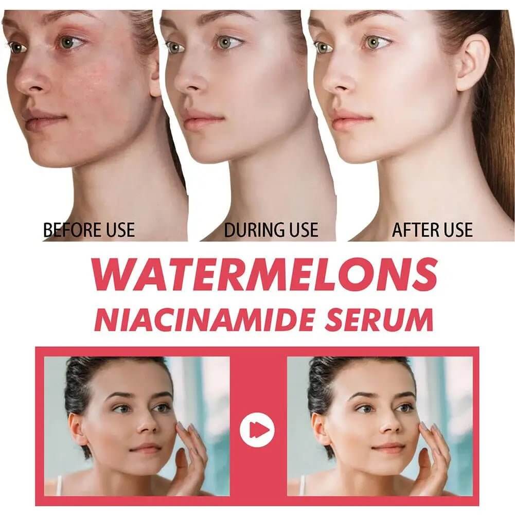 Watermelon Glow Niacinamide Moisturize Serum,Moisturizing Facial Serum W/ Hyaluronic Acid Vitamin E,Hydrating Brighten Skincare - The Skin Essence